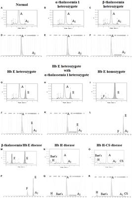 Update in Laboratory Diagnosis of Thalassemia